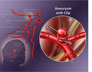 Brain Aneurysm Surgery